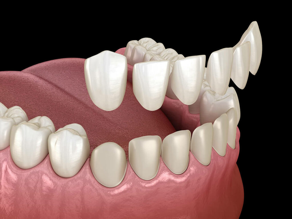 Illustration of dental veneers.