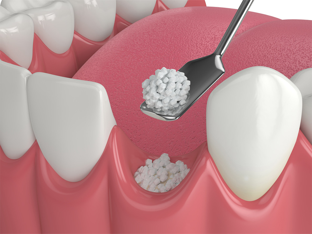 Illustration of a dental bone grafting procedure.