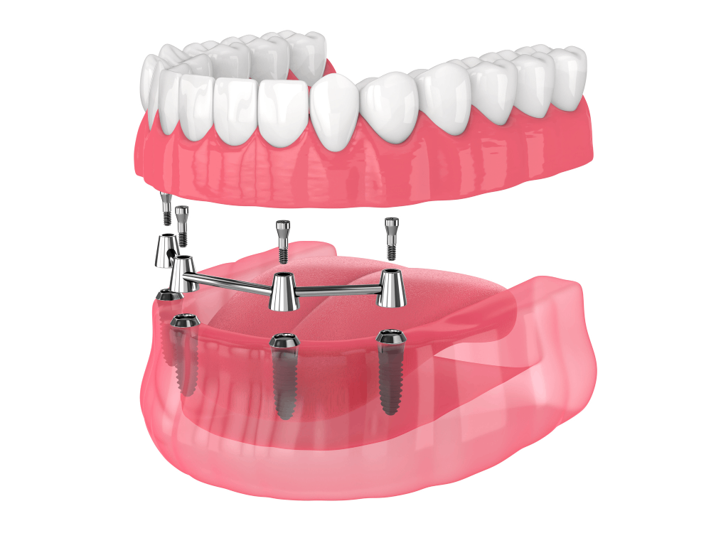 Illustration of implant-supported dentures.