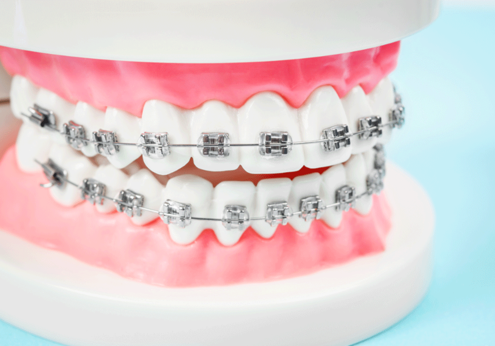 Photo of metal braces.